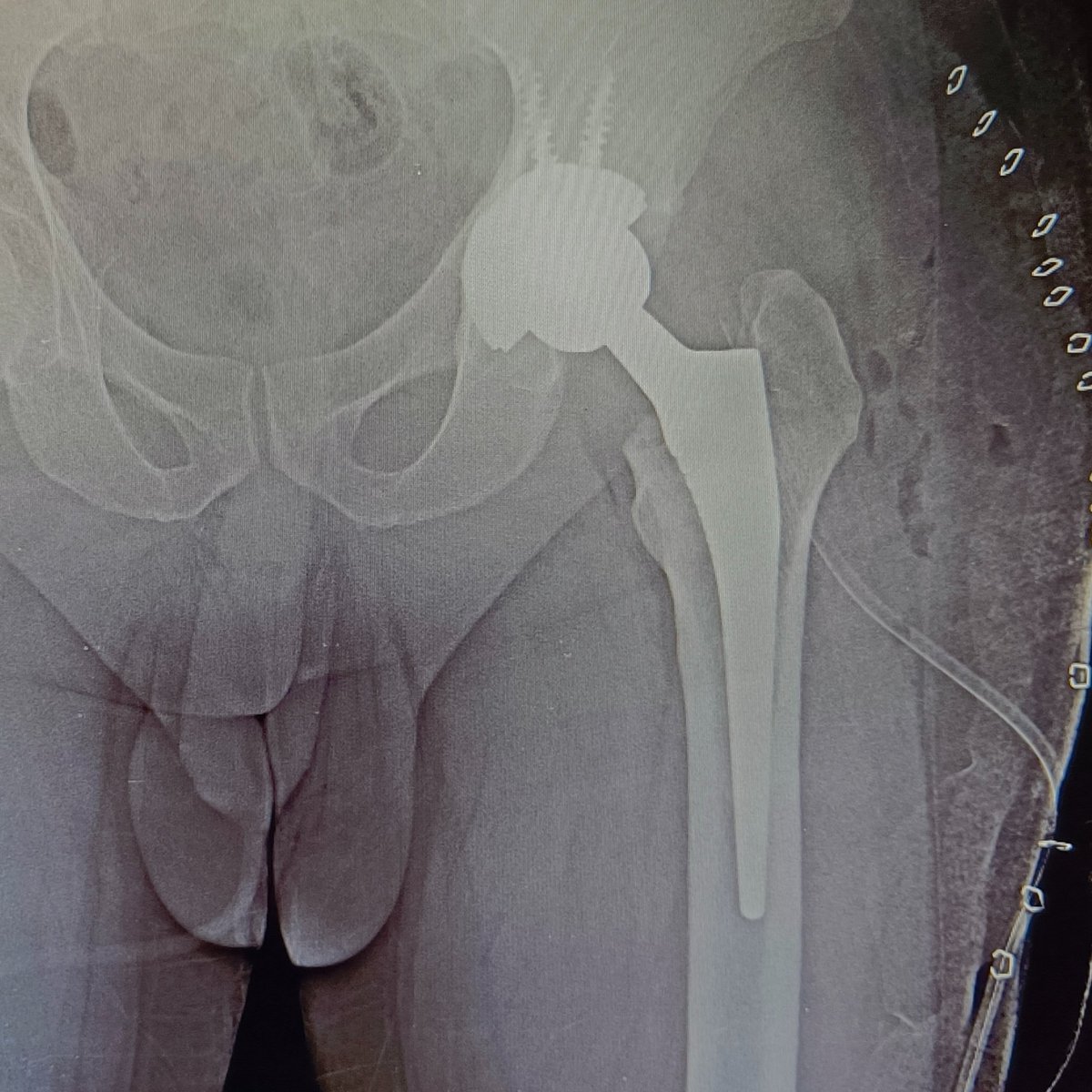 Ceramic on poly hip replacement surgery 

Posterior approach 

#MedTwitter #orthotwitter #orthox