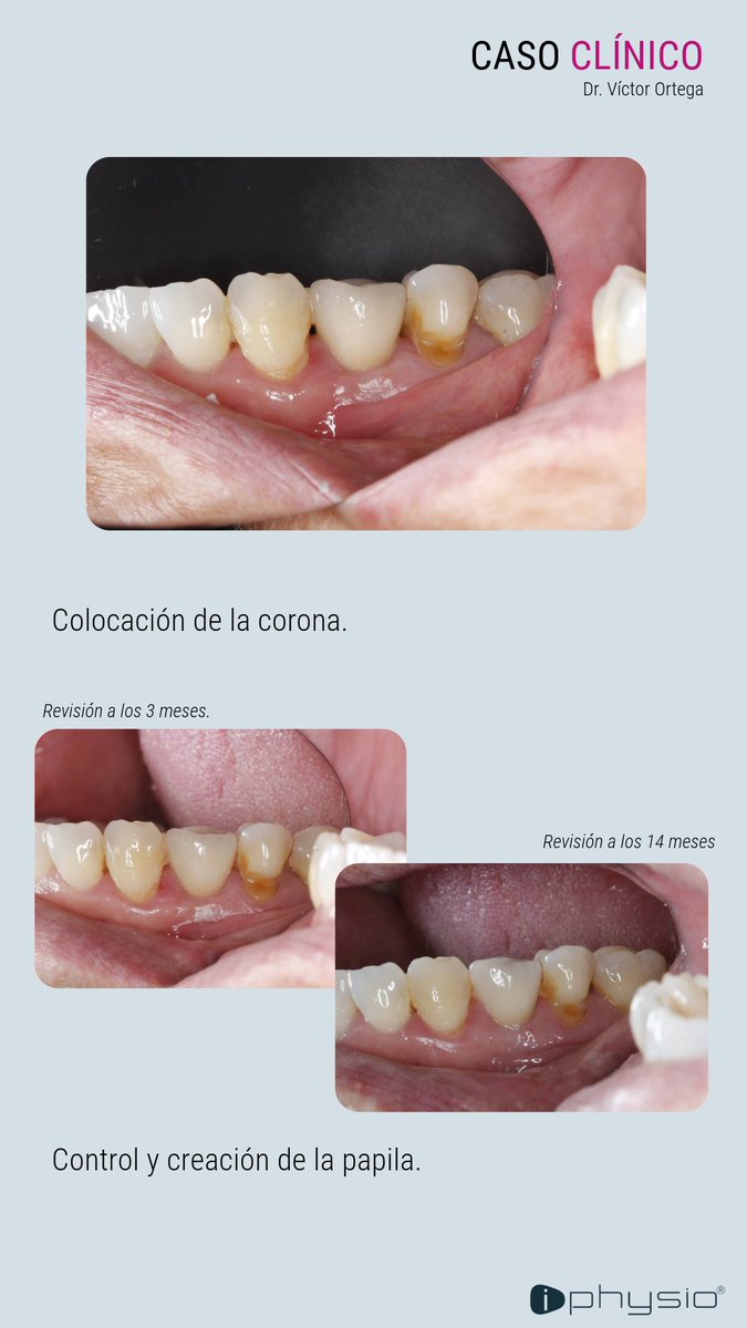 🔎CASO CLÍNICO

Descubre las imágenes clínicas del Dr Víctor Ortega sobre el protocolo iPhysio®.

Para otros casos clínicos, consulta AQUÍ 👇 iphysio.dental/es/casos_clini…

Simple. Safe. Accesible😊

#lyraetk #etkimplant #implantology #iphysiodental #implantesdentales #casosclinicos