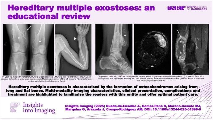 Hereditary multiple exostoses is an autosomal dominant disorder causing multiple osteochondromas, often asymptomatic but can lead to deformities, fractures, bursitis, or malignant transformation. There is a 10% risk of malignant transformation into secondary chondrosarcoma.