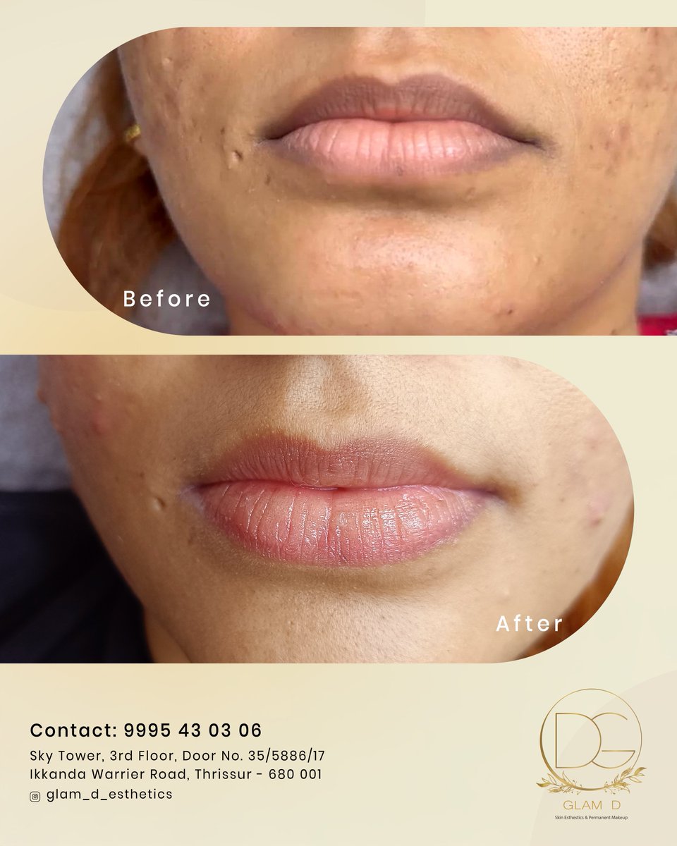 GlamE96397's tweet photo. Our specialized solutions gently reduce pigmentation, restoring your lips natural colour

Book your appointment today :
📞 9995 43 03 06
📍 Thrissur
.
.
#DarkLipCorrection #LipCare #HealthyLips #GlamD #BeautyTreatment #LipPigmentation https://t.co/UKZLemJU72