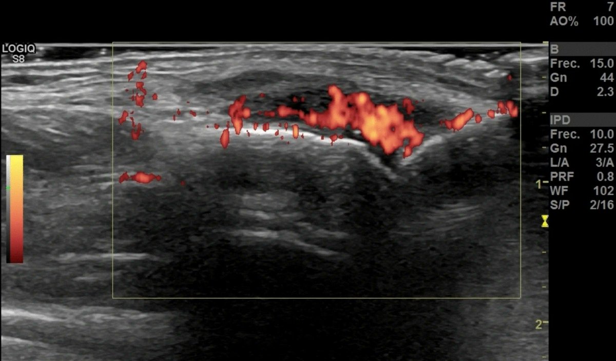 AnnalsSagratCor's tweet photo. #publ_huscor Añez G,  (...) Vilella MC, et al. Clinical and ultrasound optimization in rheumatoid arthritis for patients in sustained remission, can it work as a new optimization tool? J Ultrasound. 2025;28:81-7. doi: 10.1007/s40477-024-00963-z.  
https://t.co/FhB16fqjQ4 https://t.co/yCgoU7PYZ9