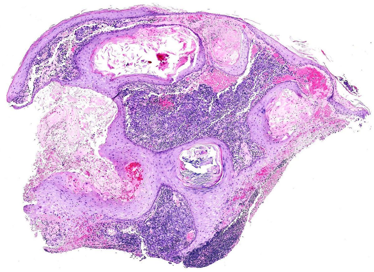 AnnalsSagratCor's tweet photo. #publ_husc Corral-Forteza M, Pérez-Muñoz N, et al. Postherpetic Pseudolymphomatous Angiosarcoma Concealed Within Milia en Plaque: Expanding the Spectrum of Wolf Isotopic Response with a Literature Review https://t.co/Jv35abMWRh #mdpidermatopathology a través de @Der_MDPI https://t.co/5QAhVTLB1E