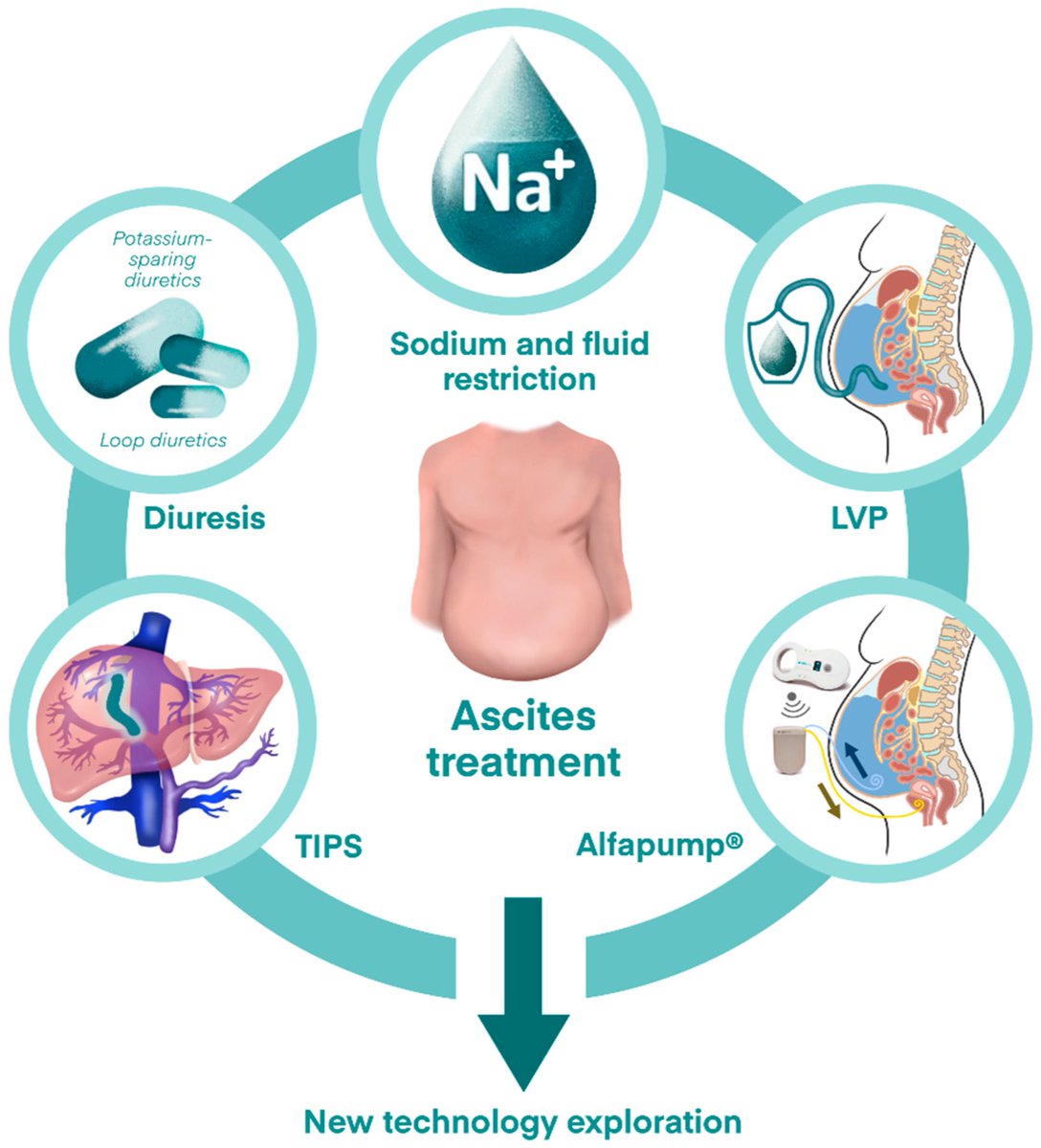 Terry Cheuk-Fung Yip (@terryyip12) on Twitter photo #Ascites is a key sign of #cirrhosis decompensation reflecting worsening portal hypertension. We explore challenges & controversies in its treatment.🔗shorturl.at/krTKt <a href="/JimmyLaiCT/">Jimmy Che-To Lai</a> <a href="/VWSWong/">Vincent Wong</a> <a href="/wonglaihung/">Grace Wong</a> <a href="/CUHKGI/">CUHK Gastroenterology & Hepatology</a> <a href="/CUHKMedicine/">CUHK Medicine</a> #Ascites is a key sign of #cirrhosis decompensation reflecting worsening portal hypertension. We explore challenges & controversies in its treatment.🔗shorturl.at/krTKt <a href="/JimmyLaiCT/">Jimmy Che-To Lai</a> <a href="/VWSWong/">Vincent Wong</a> <a href="/wonglaihung/">Grace Wong</a> <a href="/CUHKGI/">CUHK Gastroenterology & Hepatology</a> <a href="/CUHKMedicine/">CUHK Medicine</a>