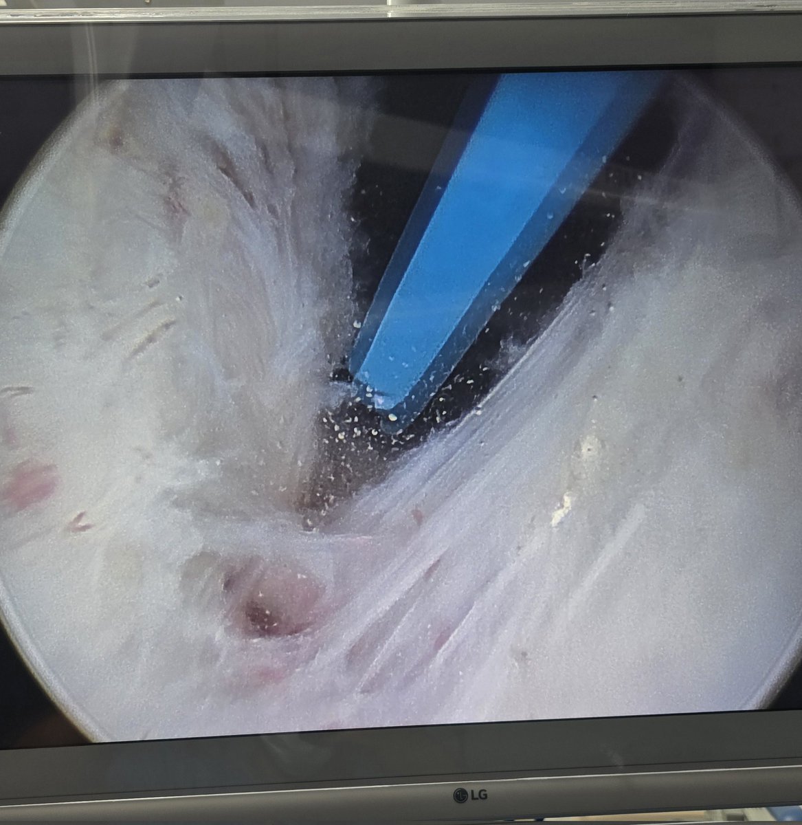 L'art de l'énucléation

#aeep #holep #enucleation #bph
<a href="/so_uro/">UroSoMe</a>