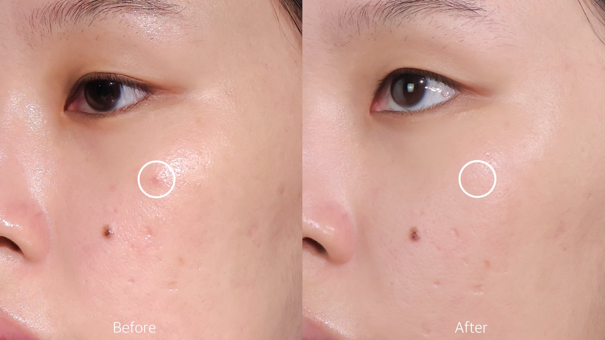 ทุกวันนี้เวลาสิวขึ้น เราจะชอบหยิบ effaclar duo+m  มาแต้มทาตลอด มันเคลียร์เร็วอะ จบใน 1 หลอดดี ถ้าอักเสบก็แห้งยุบไป ถ้าอุดตันก็ดันออกไม่ทิ้งรอย โคตรจะปึ้ง แล้วยังช่วยลดความมัน ปรับสมดุลผิวให้สิวขึ้นน้อยลง ลดการเกิดสิวซ้ำซาก รอยดำจากสิวก็จางลงอีก เป็นเนื้อเจลสบายๆ ซึมไว ไม่เหนอะเลย หยิบกี่ทีก็อิน🥺

#LaRochePosayTH #Effaclar #ลาโรชโพเซย์ #เอฟฟาคลาร์ #เอฟฟาคลาร์ดูโอพลัสเอ็ม #ลดสิว #รอยสิว #EffaclarDuo #ผิวมัน