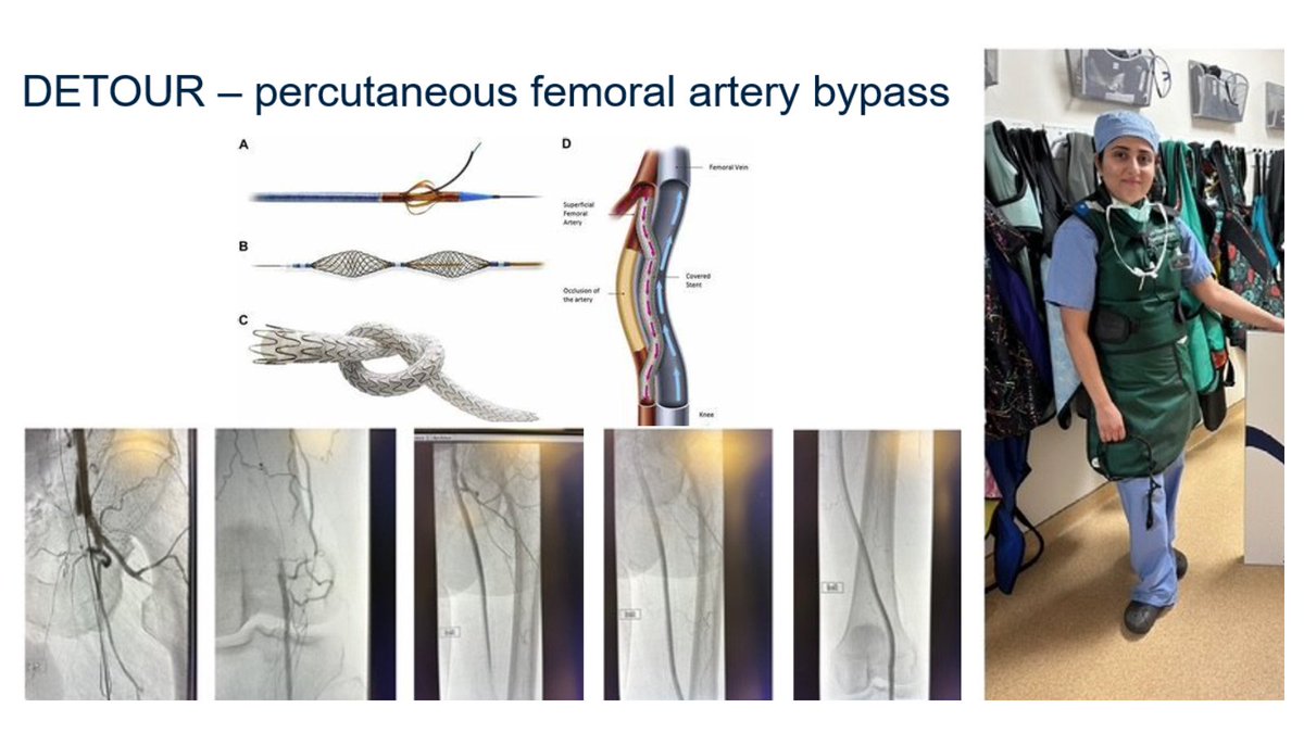 Lancaster General's #RuhaniNanavatiMD 🩺 performed the 1st Percutaneous Transmural Arterial Bypass (PTAB).

The new therapy for patients with complex #PAD uses the femoral vein to bypass blockages in the superficial femoral artery. 

#PTAB