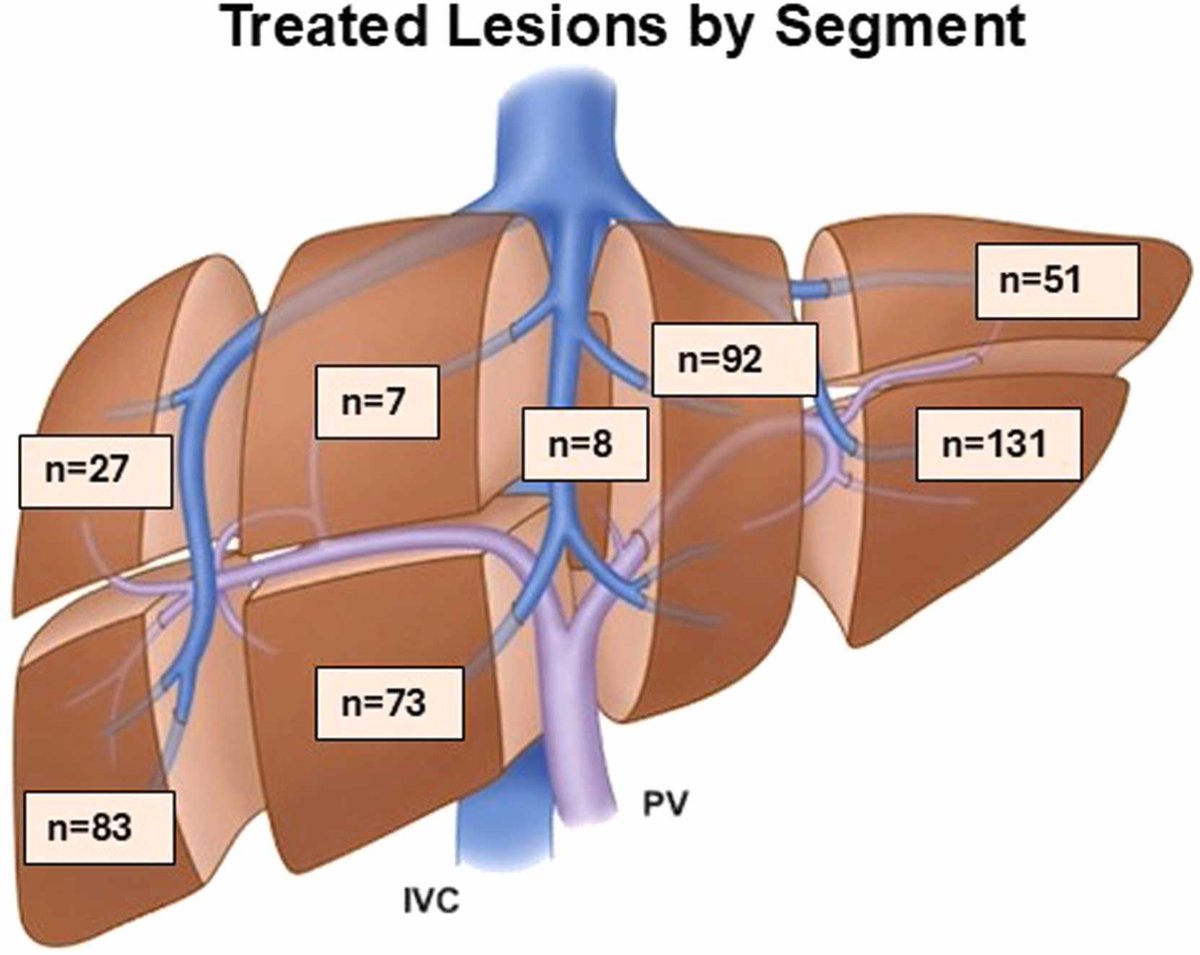 Elsevier GastroHep (@elsgastro) on Twitter photo Check out the latest from JOGS article on histotripsy. It details the first international experience and a comprehensive safety analysis of 230 cases: spkl.io/6018fQOfi
@journalofGIsurg
<a href="/heatheryeomd/">Heather Yeo MD</a> Check out the latest from JOGS article on histotripsy. It details the first international experience and a comprehensive safety analysis of 230 cases: spkl.io/6018fQOfi
@journalofGIsurg
<a href="/heatheryeomd/">Heather Yeo MD</a>