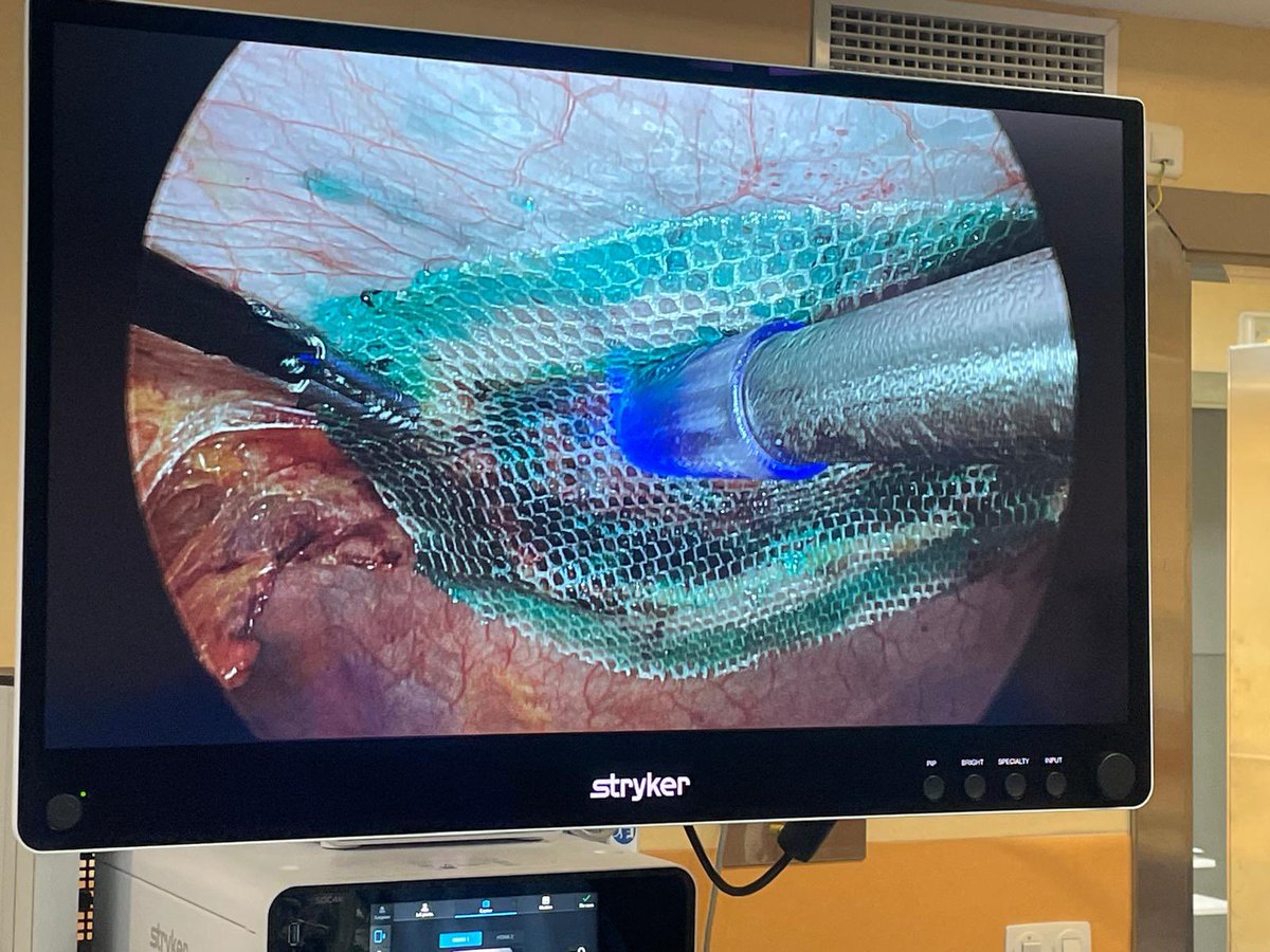 Salvador Morales Conde (@smoralesconde) on Twitter photo We have started at the <a href="/CirugiaHosp/">Cirugia General. Hosp. Univ. Virgen Macarena</a> the first cases of a preclinical study using a glue that is activated by a blue light when performing a LIRA to repair for a ventral hernia avoiding mechanical fixation
<a href="/EAES_eu/">EAES</a> <a href="/eurohernias/">European Hernia Society</a> <a href="/scmi_itec/">aec_cmi</a> We have started at the <a href="/CirugiaHosp/">Cirugia General. Hosp. Univ. Virgen Macarena</a> the first cases of a preclinical study using a glue that is activated by a blue light when performing a LIRA to repair for a ventral hernia avoiding mechanical fixation
<a href="/EAES_eu/">EAES</a> <a href="/eurohernias/">European Hernia Society</a> <a href="/scmi_itec/">aec_cmi</a>