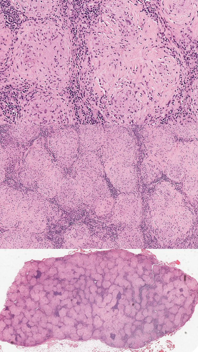CT showed bilateral symmetric hilar and right paratracheal lymphadenopathy

This is a hilar lymph node.

What is the diagnosis?
A) Granulomatosis with polyangiitis
B) Rheumatoid nodule
C) Sarcoidosis
D) Tuberculosis
🔬dpa-dapa.com/public/display…
#PulmPath #PathTwitter #Pathology