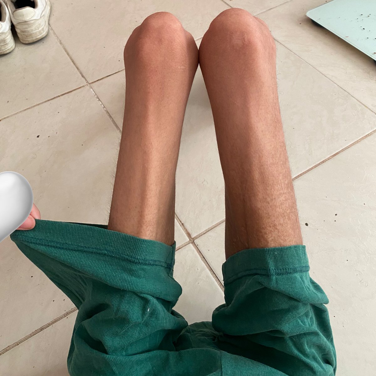 skinnlheart's tweet photo. bmi 20 -> bmi 10
same pants https://t.co/8RdZkrvBAc