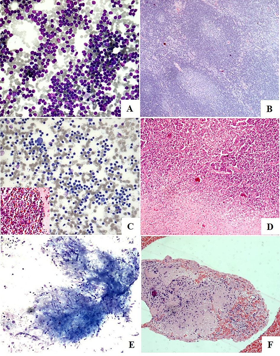 CancerCytopath's tweet image. FNAC is a highly accurate and specific test for lymph node (LN) pathology, especially in the pediatric population. The incorporation of the Sydney system helps to achieve uniformity and reproducibility in LN cytology diagnosis.

acsjournals.onlinelibrary.wiley.com/doi/full/10.10…

#CytoPath #FNAPath