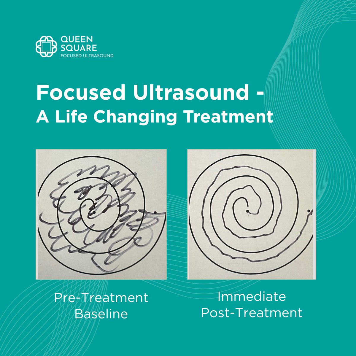 QueenSquareFUS's tweet image. One Treatment. A life-changing difference.
Patients treated with Focused Ultrasound attempt to draw a continuous circle before and after treatment. The results speak for themselves.
🔗 - vist.ly/3mys9s9
#PatientSuccess #TremorTreatment #EssentialTremor #QueenSquare