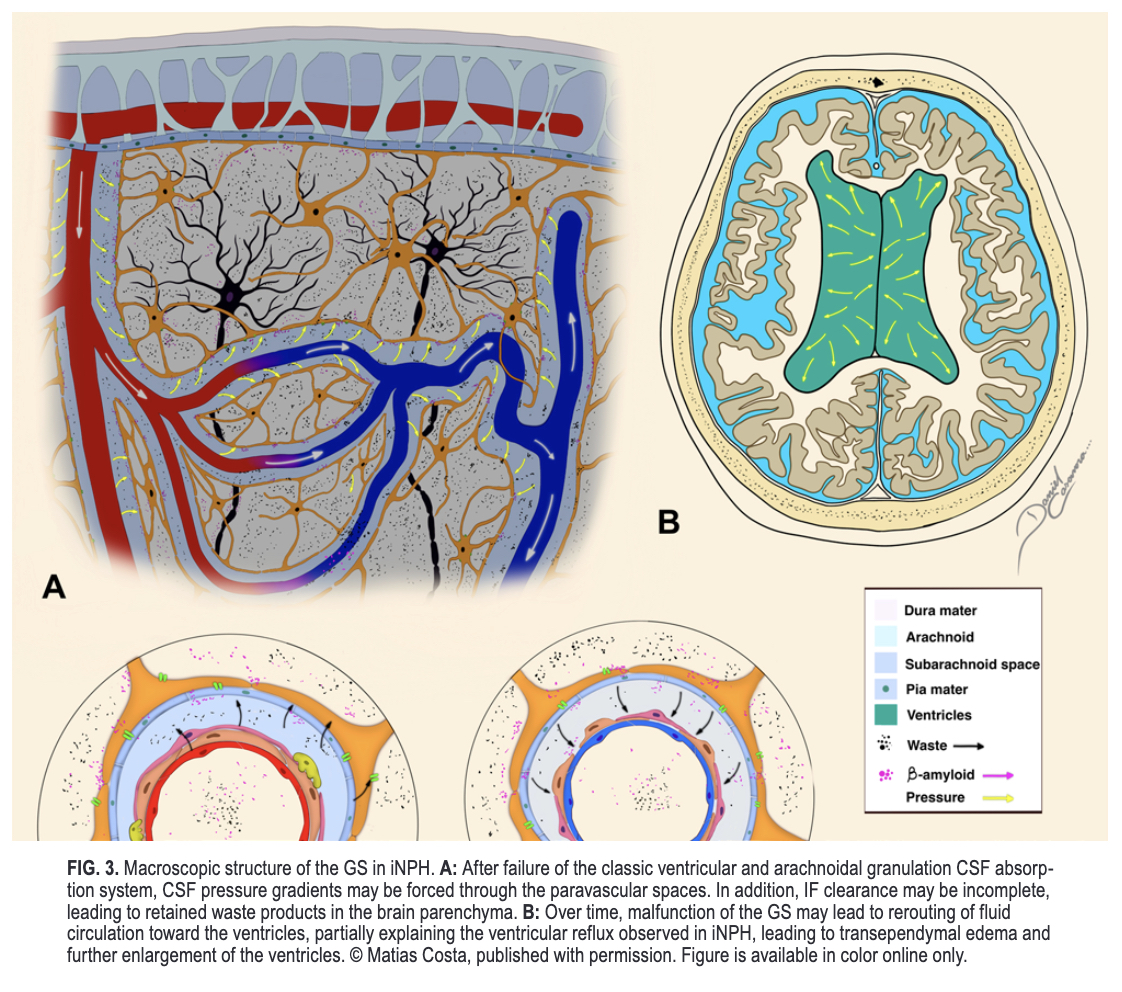 #OnlineFirst: Implications of the glymphatic system in the pathogenesis of normal pressure hydrocephalus: an illustrated scoping review. 

thejns.org/view/journals/….