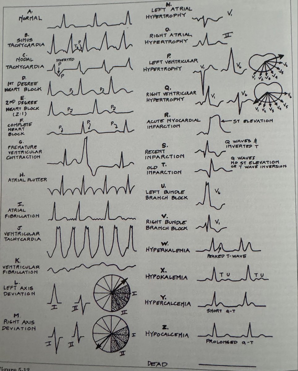 EKG cheat sheet