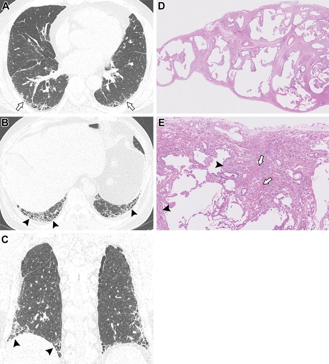 In this retrospective study, Park et al report on the prognostic value of autoimmune features associated with CT patterns of idiopathic pulmonary fibrosis and pathologic usual interstitial pneumonia. <a href="/ChoeMDRad/">Jooae Choe MD PhD</a> bit.ly/4iHqN0e