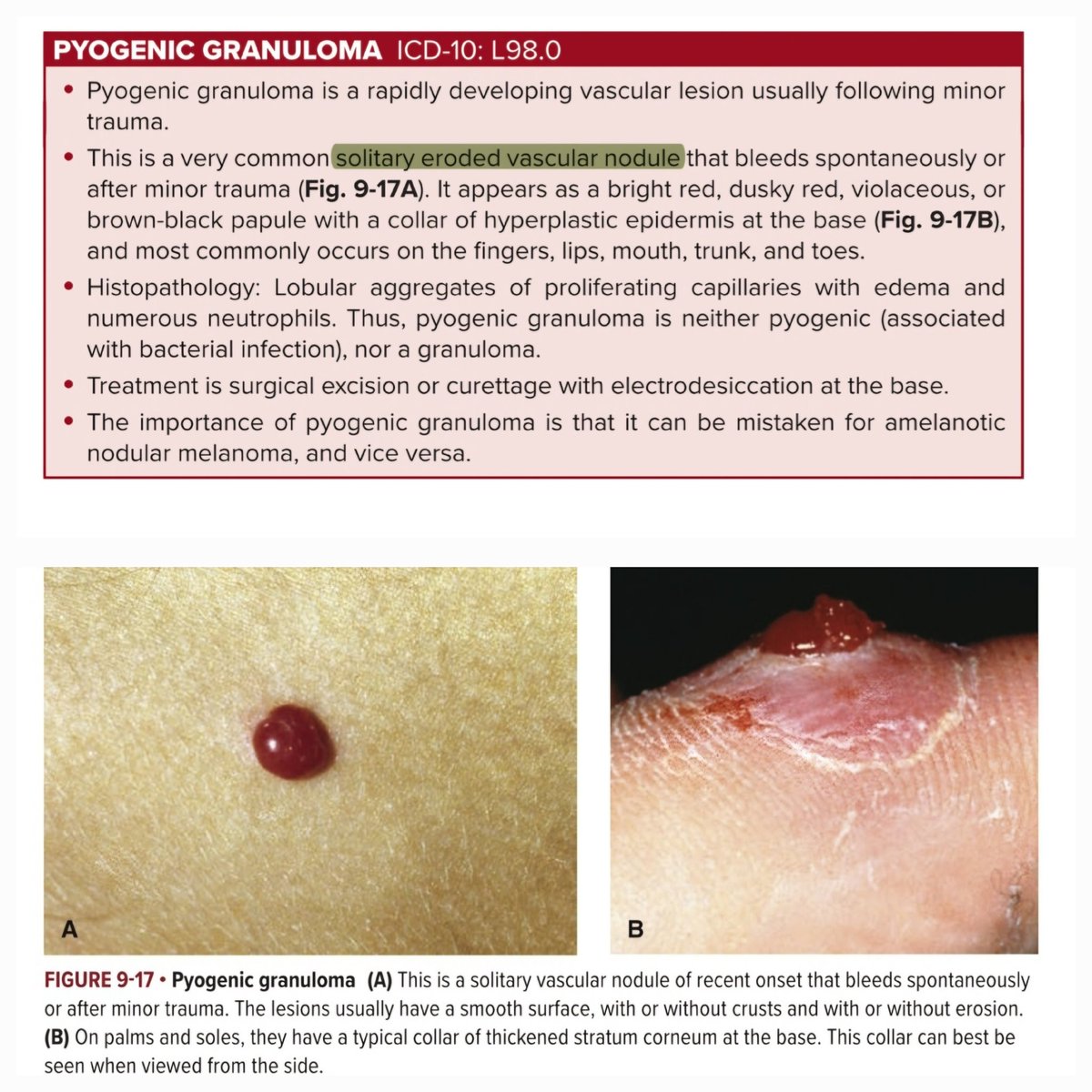 zallballen's tweet photo. Pyogenic Granuloma a misnomer
Cc: FCAS Clin Dermatology 9e.

#MedTwitter 
#AprilFoolsDay 
#aprilfoolsday2025 
#MedX https://t.co/9YvVv55UMa