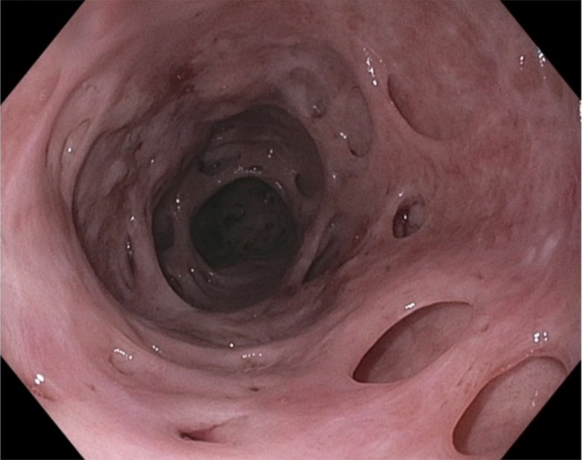 ACGCRJ (@acgcrj) on Twitter photo 🗣️Image Challenge⏱️#ACGCRJ
👉What are EGD Findings🔍
👉What's your differential diagnosis🎯
📚 bit.ly/3FOm5zg
<a href="/AmCollegeGastro/">ACG</a> <a href="/NadeemYousafMD/">Nadeem Yousaf</a> <a href="/PrateekHarne1/">Prateek Harne MBBS, MD</a> <a href="/HZaverMD/">Himesh Zaver, MD</a> <a href="/TelbanyMD/">Ahmed Telbany MD, MPH</a> <a href="/umer446/">Umer Farooq</a> <a href="/Dmarino117/">Dan Marino MD MBA</a> <a href="/CCF_GIFellows/">CCF GI Fellowship</a> <a href="/CWRU_GI/">CWRU-GI/Case Western GI Fellowship</a> <a href="/Khushbupatel25/">Khushbu Patel</a>
#GITwitter #MedTwitter 🗣️Image Challenge⏱️#ACGCRJ
👉What are EGD Findings🔍
👉What's your differential diagnosis🎯
📚 bit.ly/3FOm5zg
<a href="/AmCollegeGastro/">ACG</a> <a href="/NadeemYousafMD/">Nadeem Yousaf</a> <a href="/PrateekHarne1/">Prateek Harne MBBS, MD</a> <a href="/HZaverMD/">Himesh Zaver, MD</a> <a href="/TelbanyMD/">Ahmed Telbany MD, MPH</a> <a href="/umer446/">Umer Farooq</a> <a href="/Dmarino117/">Dan Marino MD MBA</a> <a href="/CCF_GIFellows/">CCF GI Fellowship</a> <a href="/CWRU_GI/">CWRU-GI/Case Western GI Fellowship</a> <a href="/Khushbupatel25/">Khushbu Patel</a>
#GITwitter #MedTwitter