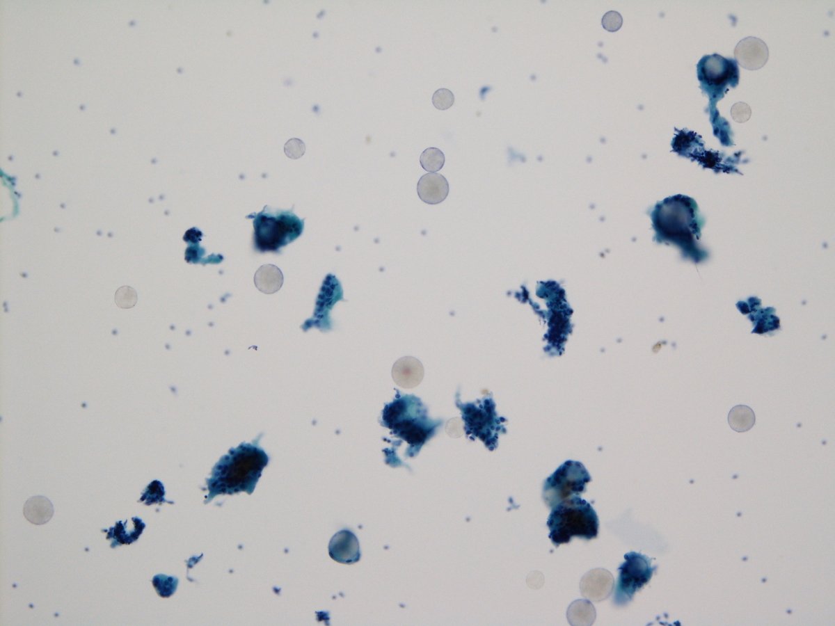 jfhang's tweet image. A 56 y/o female presents with a progressively hard left buccal mass with swelling and mild pain on compression. Just receive this case after I saw the post from @JaylouVelez
Dx: foreign body granulomatous reaction to Radiesse (calcium hydroxylapatite)
#FNApath #cytopath