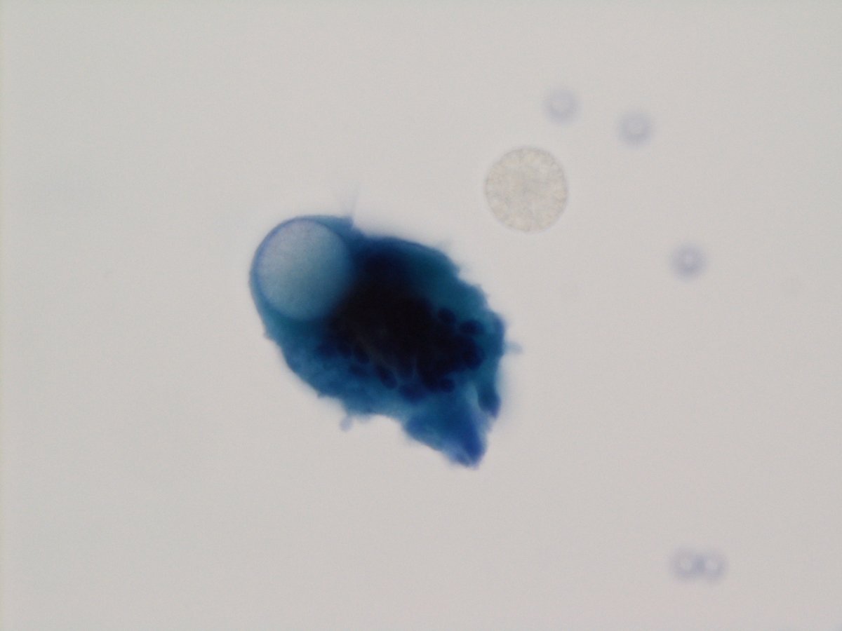 jfhang's tweet image. A 56 y/o female presents with a progressively hard left buccal mass with swelling and mild pain on compression. Just receive this case after I saw the post from @JaylouVelez
Dx: foreign body granulomatous reaction to Radiesse (calcium hydroxylapatite)
#FNApath #cytopath