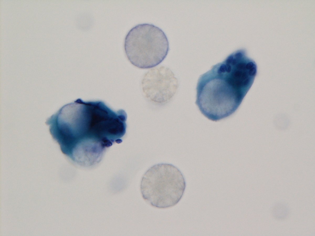 jfhang's tweet image. A 56 y/o female presents with a progressively hard left buccal mass with swelling and mild pain on compression. Just receive this case after I saw the post from @JaylouVelez
Dx: foreign body granulomatous reaction to Radiesse (calcium hydroxylapatite)
#FNApath #cytopath