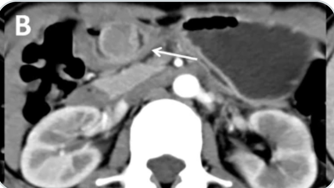 Abdominal Radiology (@abdominal_rad) on Twitter photo CT features of gastric calcifying fibrous tumors: differentiation from gastrointestinal stromal tumors
Bo Tang et al
#AbdRadJ
<a href="/RadGeek/">Neeraj Lalwani</a>
<a href="/LetDdiceFlyHigh/">Sandeep Arora</a>
link.springer.com/article/10.100… CT features of gastric calcifying fibrous tumors: differentiation from gastrointestinal stromal tumors
Bo Tang et al
#AbdRadJ
<a href="/RadGeek/">Neeraj Lalwani</a>
<a href="/LetDdiceFlyHigh/">Sandeep Arora</a>
link.springer.com/article/10.100…