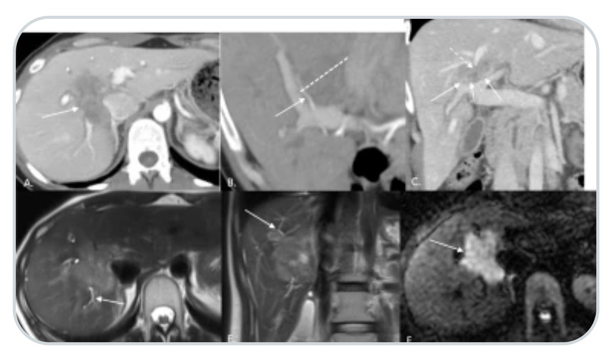 Abdominal Radiology (@abdominal_rad) on Twitter photo Standardized reporting of intrahepatic cholangiocarcinoma
link.springer.com/article/10.100…
Andrea Siobhan Kierans et al
#AbdRadJ
<a href="/RadGeek/">Neeraj Lalwani</a>
<a href="/LetDdiceFlyHigh/">Sandeep Arora</a> Standardized reporting of intrahepatic cholangiocarcinoma
link.springer.com/article/10.100…
Andrea Siobhan Kierans et al
#AbdRadJ
<a href="/RadGeek/">Neeraj Lalwani</a>
<a href="/LetDdiceFlyHigh/">Sandeep Arora</a>