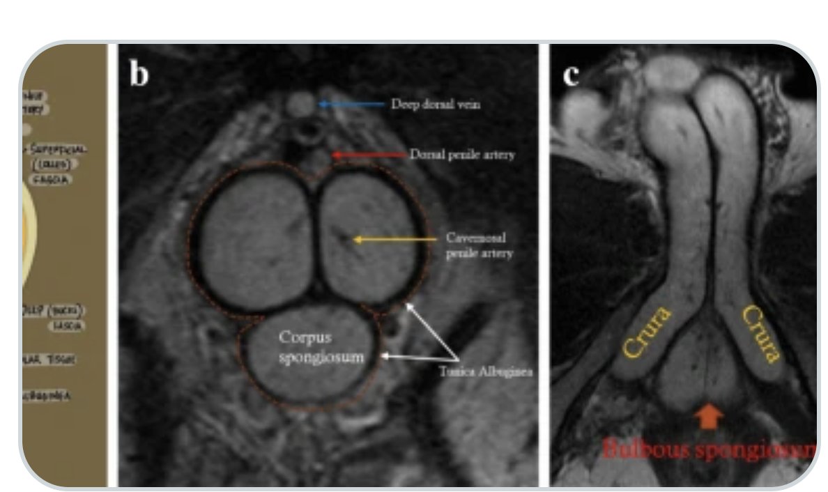 Abdominal Radiology (@abdominal_rad) on Twitter photo MR imaging of the penis: What a radiologist needs to know!
link.springer.com/article/10.100…
Shruti Kumar et al
#AbdRadJ
<a href="/RadGeek/">Neeraj Lalwani</a>
<a href="/LetDdiceFlyHigh/">Sandeep Arora</a> MR imaging of the penis: What a radiologist needs to know!
link.springer.com/article/10.100…
Shruti Kumar et al
#AbdRadJ
<a href="/RadGeek/">Neeraj Lalwani</a>
<a href="/LetDdiceFlyHigh/">Sandeep Arora</a>
