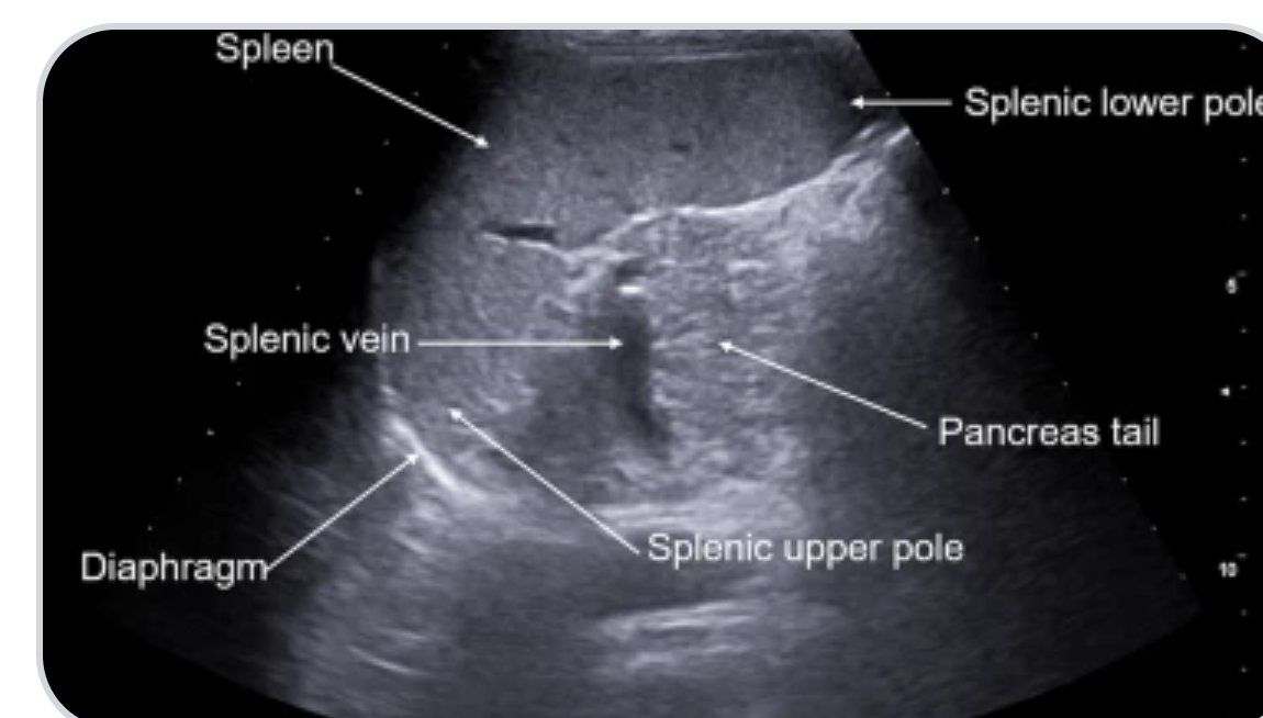 Abdominal Radiology (@abdominal_rad) on Twitter photo Diagnostic insights into splenic pathologies: the role of multiparametric ultrasound
link.springer.com/article/10.100…
Davide Roccarina et al
#AbdRadJ
<a href="/RadGeek/">Neeraj Lalwani</a>
<a href="/LetDdiceFlyHigh/">Sandeep Arora</a> Diagnostic insights into splenic pathologies: the role of multiparametric ultrasound
link.springer.com/article/10.100…
Davide Roccarina et al
#AbdRadJ
<a href="/RadGeek/">Neeraj Lalwani</a>
<a href="/LetDdiceFlyHigh/">Sandeep Arora</a>