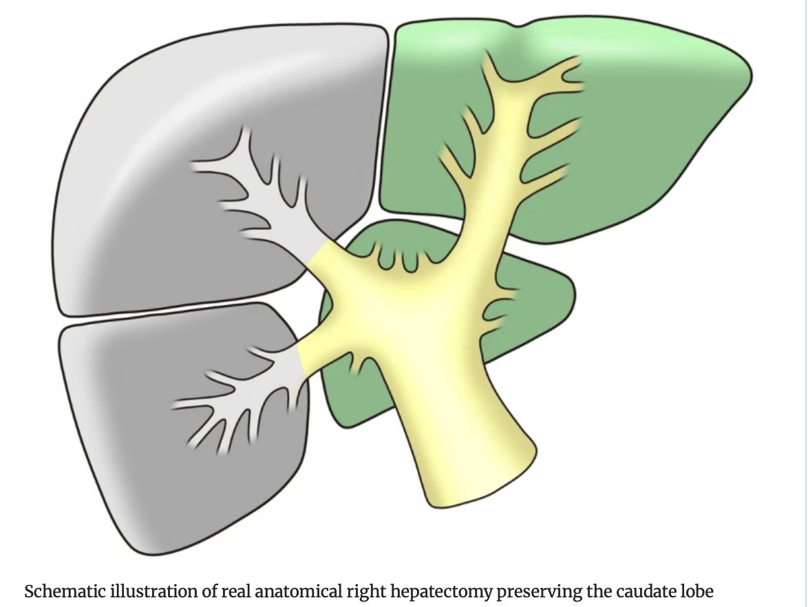 Annals of Surgical Oncology (@annsurgoncol) on Twitter photo April Issue: Robotic Real Anatomical Right #Hepatectomy Preserving the Caudate Lobe: Separate Dissection of the Right Anterior and Posterior Glissonean Pedicles, Combined with the Use of ICG Fluorescent Imaging
rdcu.be/ef1xu
<a href="/CamilleLStewart/">Camille Stewart, MD</a>
<a href="/SyedAAhmad5/">Syed A. Ahmad</a> April Issue: Robotic Real Anatomical Right #Hepatectomy Preserving the Caudate Lobe: Separate Dissection of the Right Anterior and Posterior Glissonean Pedicles, Combined with the Use of ICG Fluorescent Imaging
rdcu.be/ef1xu
<a href="/CamilleLStewart/">Camille Stewart, MD</a>
<a href="/SyedAAhmad5/">Syed A. Ahmad</a>