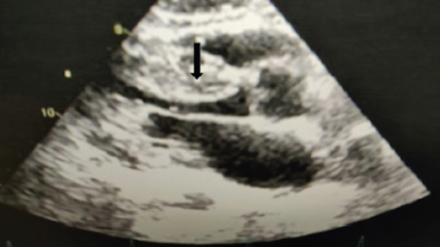 radcliffeCARDIO's tweet image. 📚New #USCJournal Article: "Transthyretin Cardiac Amyloidosis: A Right-atrial Variant"

📚 Just Published!

🔓Access it here 👉 ow.ly/OXgJ1064ogx

@CardioNerds #CVImaging #MedEd #HeartFailure #CardioTwitter