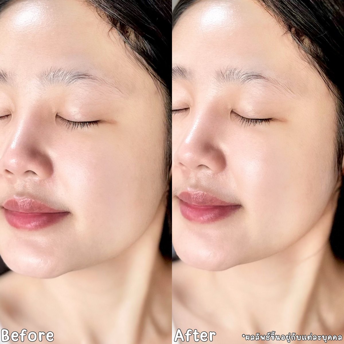 ช่วงนี้กันแดดที่ชอบมากแล้วต้องทาทุกวันยกให้น้องกันแดดวิตซีเบาผิวตัวนี้ของ Garnier เลย ชอบมากกก 💛✨ เนื้อเซรั่มคือเบาผิวสุดๆ ชอบที่หลังทาคือหน้านุ่มมากก แล้วป้องกันแดดได้ 99% เลย พร้อมป้องกันผิวหมองคล้ำด้วยวิตซีในตัวเดียวแบบจบๆ แล้วผิวไบรท์ขึ้นมาก ชอบบบ ไปลองโลดดด🌞