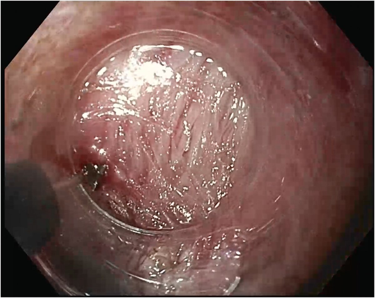 TIGE (@aga_tige) on Twitter photo 📸 Peroral Endoscopic Myotomy (POEM) and Its Use in Esophageal Dysmotility
👨⚕️ <a href="/gastrowala/">Aziz Aadam</a>
🔗 ow.ly/2iRx50VqzhK 📸 Peroral Endoscopic Myotomy (POEM) and Its Use in Esophageal Dysmotility
👨⚕️ <a href="/gastrowala/">Aziz Aadam</a>
🔗 ow.ly/2iRx50VqzhK
