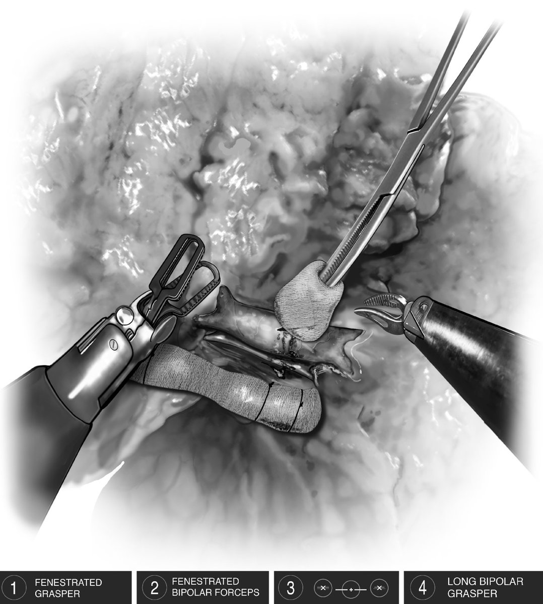 AATS (@aatshq) on Twitter photo New in Operative Techniques in #Thoracic and #Cardiovascular Surgery: Emergency Conversion From Robotic Thoracoscopy to Thoracotomy. Log in to read the abstract: doi.org/10.1053/j.opteā¦
<a href="/ElliotServaisMD/">Elliot Servais, MD, FACS</a> <a href="/DHoaglandMD/">Darian Hoagland, MD</a> <a href="/DenaShehata__/">Dena Shehata</a> <a href="/smoffattbruce1/">Susan Moffatt-Bruce</a> New in Operative Techniques in #Thoracic and #Cardiovascular Surgery: Emergency Conversion From Robotic Thoracoscopy to Thoracotomy. Log in to read the abstract: doi.org/10.1053/j.opteā¦
<a href="/ElliotServaisMD/">Elliot Servais, MD, FACS</a> <a href="/DHoaglandMD/">Darian Hoagland, MD</a> <a href="/DenaShehata__/">Dena Shehata</a> <a href="/smoffattbruce1/">Susan Moffatt-Bruce</a>