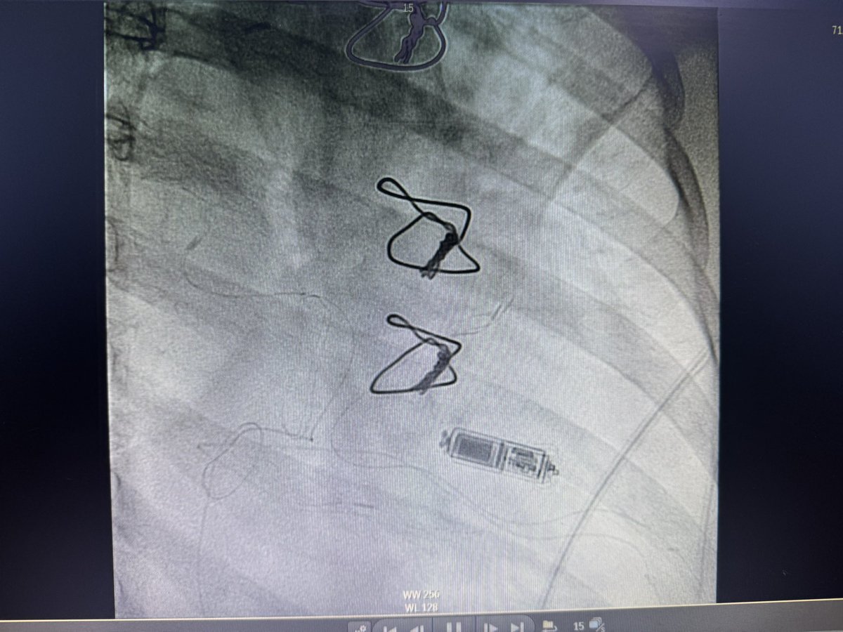 Msalmanghazni's tweet photo. “Leadless Pacemakers: A Game Changer for Patients with Tricuspid Valve Rings &amp; Bioprosthetic Valves! ⚡️💙 A revolution in pacing without the limitations of transvenous leads. #Electrophysiology #LeadlessPacing #Cardiology #Epeeps #MedTwitter #Medtronic #AVblock https://t.co/paKWTbpMrQ