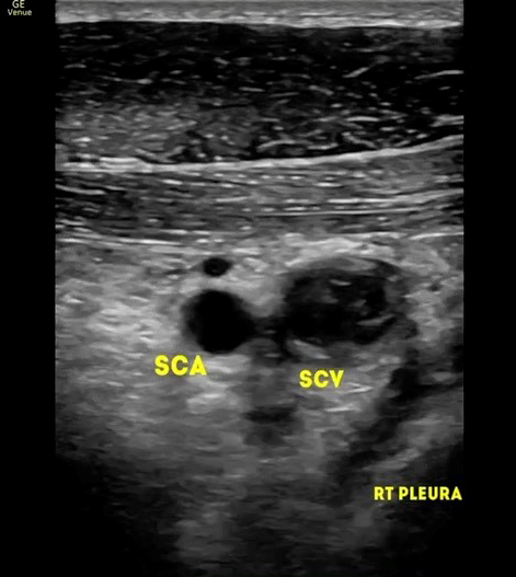 POCUS Journal Club take-home point #1: Consider POCUS for the diagnosis of Paget-Schroetter syndrome - look for signs of axillary and subclavian vein thrombosis.

pubmed.ncbi.nlm.nih.gov/36896279/