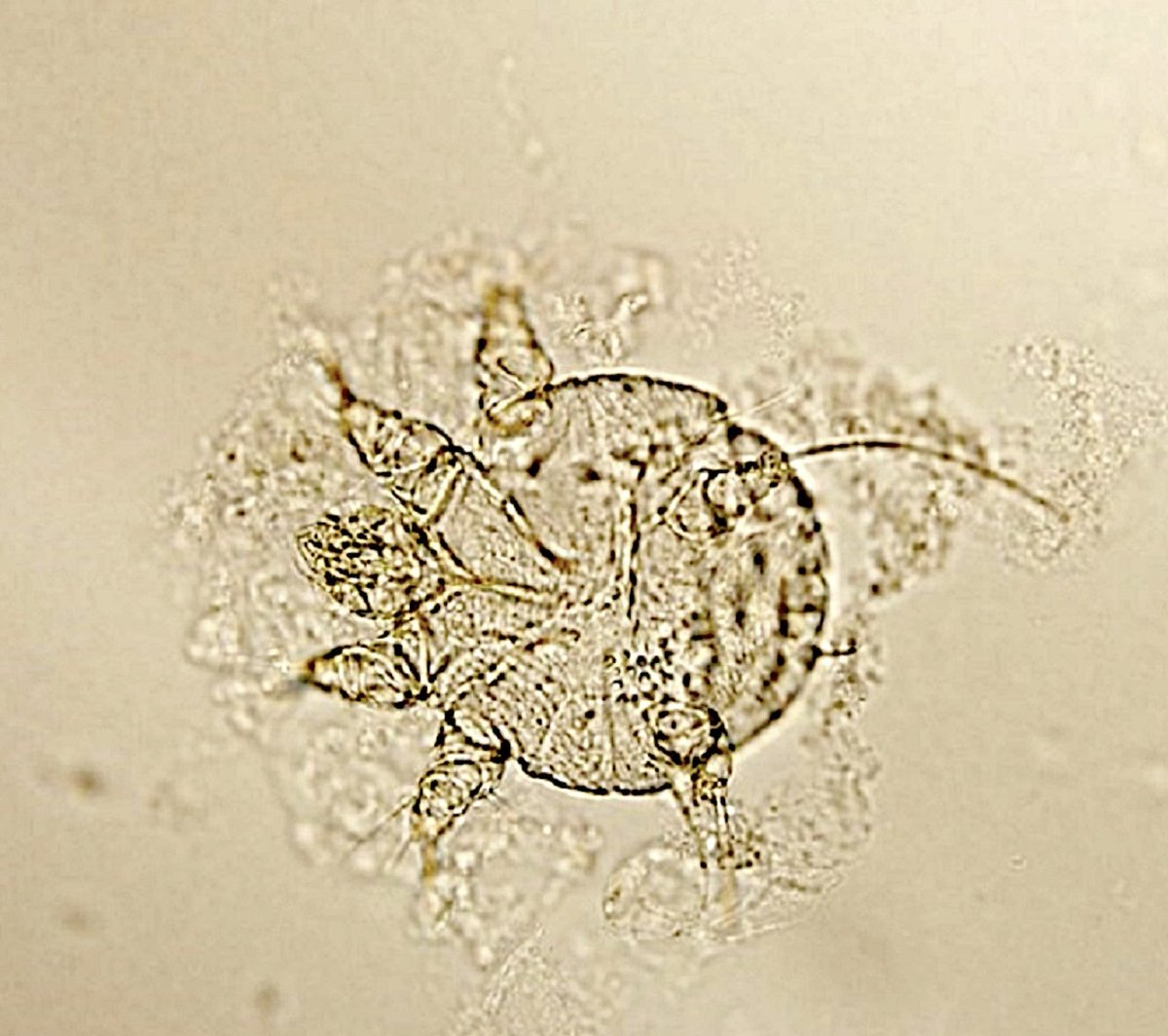Ever wonder what scabies looks like under the microscope? They really do burrow! 
#Pathology #pathX #dermpath