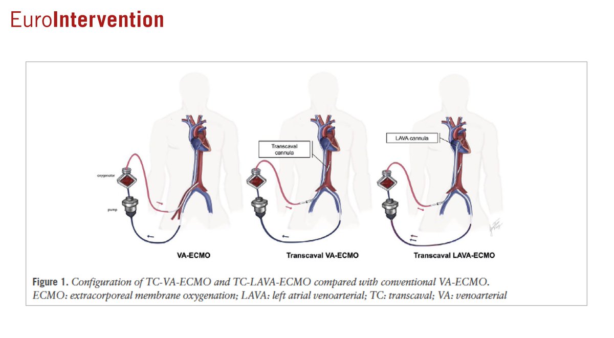 Transcaval VA-#ECMO was successfully performed in 22 patients with refractory #cardiogenicshock and no suitable peripheral access.
The approach was associated with high technical success, no limb ischaemia, and a manageable vascular complication rate.
 
ow.ly/iGeV50RjhL8
