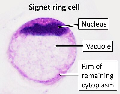 TheShorePath's tweet photo. Dx: Signet ring cell adenocarcinoma (note the abundant intracellular mucin that peripherally displaces the nucleus)
Unfortunately, this is an aggressive cancer that carries a poor prognosis as it is typically diagnosed at advanced stages https://t.co/pWBmW1UIyv