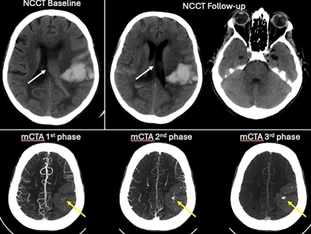 UPensato's tweet photo. Blood within the ventricles is washed out as CSF, resulting in an early hematoma retraction--the "ventricular washout phenomenon". Do you have an alternative explanation? @kojitanaka @johanna_ospel @Mohamed58605199 @mayank_G0 @bijoy
https://t.co/Gt3oYwIeaw https://t.co/CmfnfMhisy