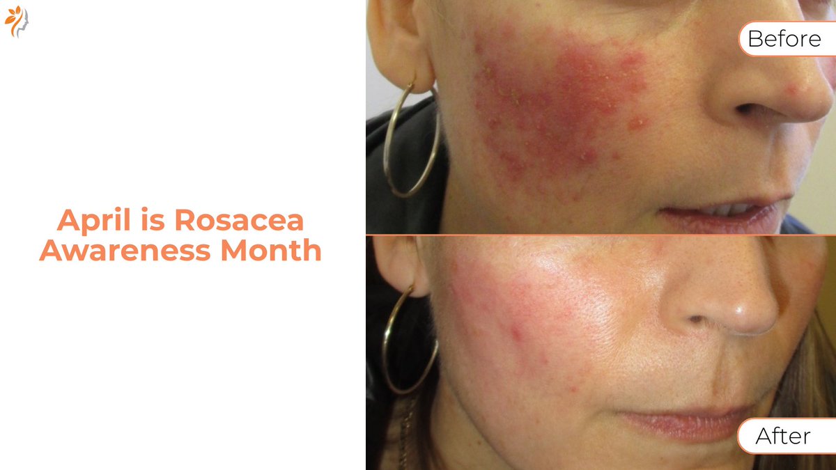 April is Rosacea Awareness Month! A chronic skin condition causing redness, visible vessels &amp; bumps. Common triggers: sun, heat, spicy food, alcohol &amp; stress. Manage with gentle skincare, SPF 30+ &amp; avoiding triggers. We can help! #RosaceaAwareness ow.ly/Ms8i50VrTi1
