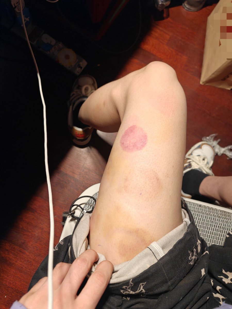 Mercury_yy's tweet photo. 喜欢拔罐是吧？苏新皓你知道有种东西叫吸阴器吗，跟拔罐类似，我会把它罩在你的馒头逼上开真空抽气，白嫩无毛的逼肉挤满了罩子紧紧贴在透明壁上，很快就从红肿变得青紫，你一定会喊疼的宝宝，没关系，亲亲就不疼了，唉不骗你了傻宝宝，其实我会在亲你的逼的时候用牙狠狠磨你的骚阴蒂 https://t.co/fLa0bFXQRC