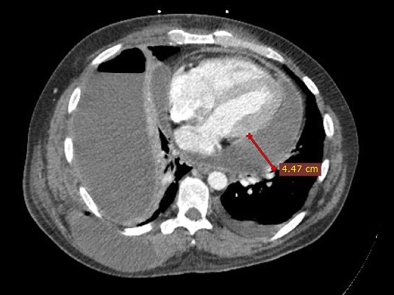 Pestrea et al. report a successfully treated case of an immunocompetent young Muay Thai fighter who developed purulent pericarditis and cardiac tamponade due to contiguous spread from an infected hydropneumothorax secondary to traumatic rib fracture. brnw.ch/21wRK97