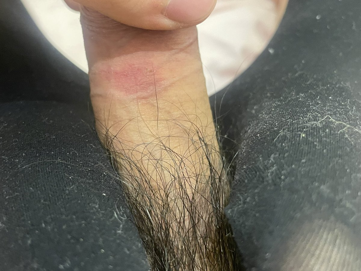 前几天练肩膀飞鸟的时候，一不留神泄力了，两个哑铃直直砸到了我的几把上当场疼的我动不了了，回家一看，红成这样了
