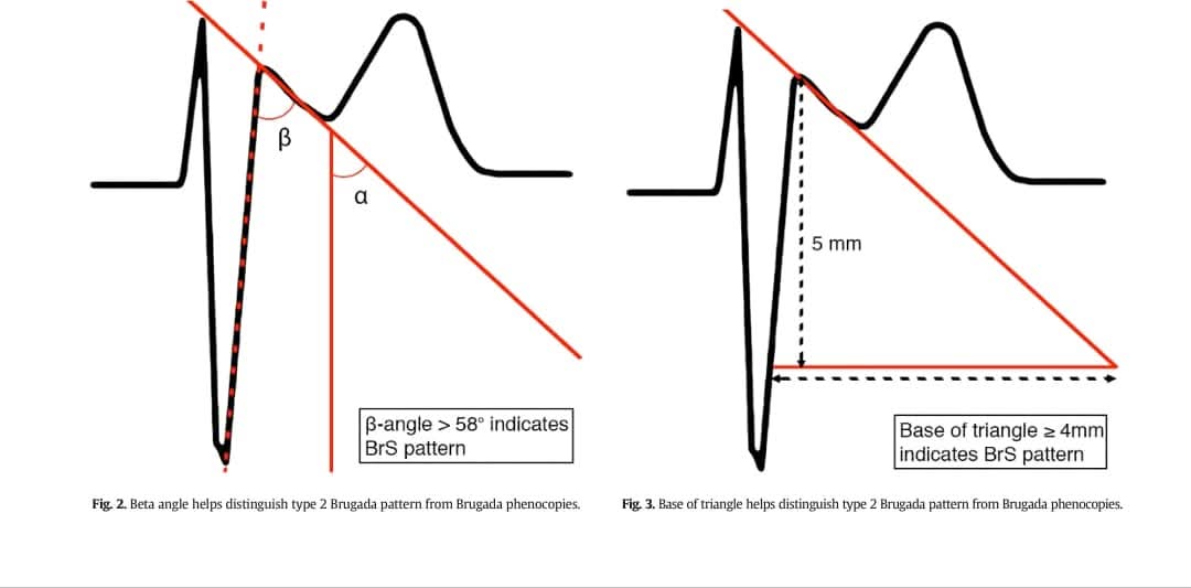 How to differentiate between incomplete Right bundle branch block(or other Brugada phenocopies)  and type 2 Brugada syndrome?

 1-Beta angel more than 58 indicates Brugada
 syndrome 
2-The base of the triangle 4 mm or more indicates Brugada syndrome

sciencedirect.com/science/articl…