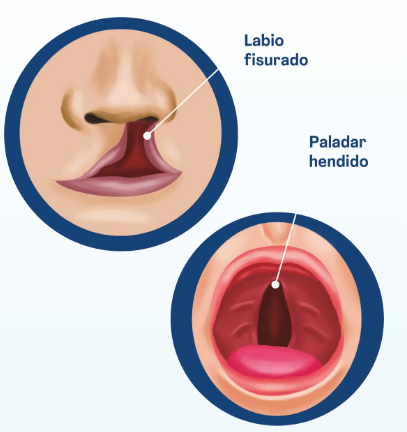 Celia_Logo's tweet photo. 📌 ¿Cómo afecta el Labio Leporino al Habla?
🔹 Dificultad en la pronunciación como la /p/, /b/, /m/ por escape de aire.
🔹 Hipernasalidad y resonancia inadecuada.
🔹 Problemas en la coordinación respiratoria para hablar.
🔹 Retraso en la adquisición del lenguaje en algunos casos. https://t.co/ZPs0YrxC9C