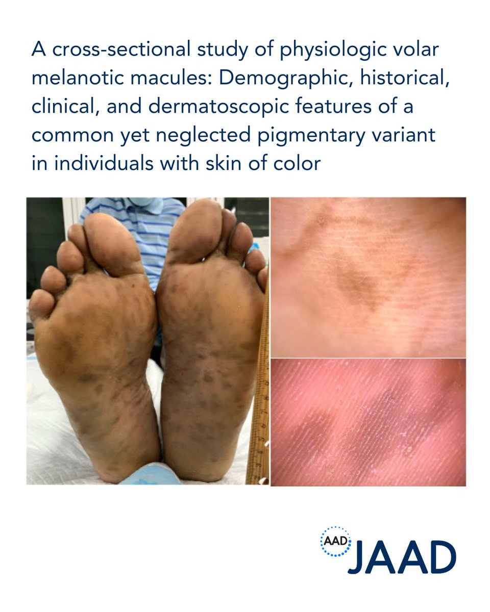 Authors of this study evaluate the clinical/historical/dermatoscopic features of physiologic volar melanotic macules in persons with skin of color. Read the full article in the April issue of JAAD. bit.ly/3YbjrcY