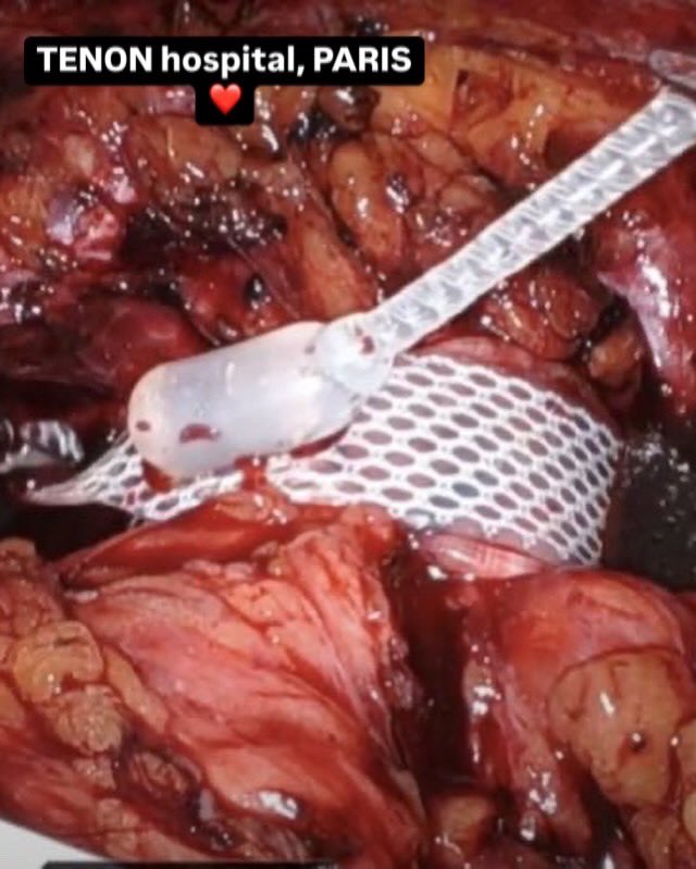 Véronique Phé (@pheveronique) on Twitter photo 🤖Intense days in robotics & functional urology!
🌍Joined <a href="/erus/">Erus rusdia</a> board with <a href="/silviasecco/">silvia secco</a>: huge recognition
✨<a href="/IMORU/">IMORU IX</a>: female sphincter among giants&rising🌟
🔜Coming at <a href="/IrcadFrance/">IrcadFrance</a>: robotics shaping functional urology
🚀 8 robot functional cases in action these last days in Paris! 🤖Intense days in robotics & functional urology!
🌍Joined <a href="/erus/">Erus rusdia</a> board with <a href="/silviasecco/">silvia secco</a>: huge recognition
✨<a href="/IMORU/">IMORU IX</a>: female sphincter among giants&rising🌟
🔜Coming at <a href="/IrcadFrance/">IrcadFrance</a>: robotics shaping functional urology
🚀 8 robot functional cases in action these last days in Paris!