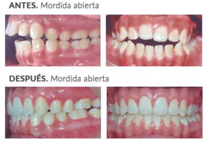 Celia_Logo's tweet photo. Mordida Abierta 🚨
❌ Existe un espacio entre los dientes superiores e inferiores cuando se cierra la boca, es decir, los dientes no se tocan.
✔️ Puede causar dificultades al comer o hablar
✔️ Problemas comunes: dificultad para pronunciar sonidos como /s/, /z/, /t/, /d/
#uv_rtl25 https://t.co/1ICSdKfmHe