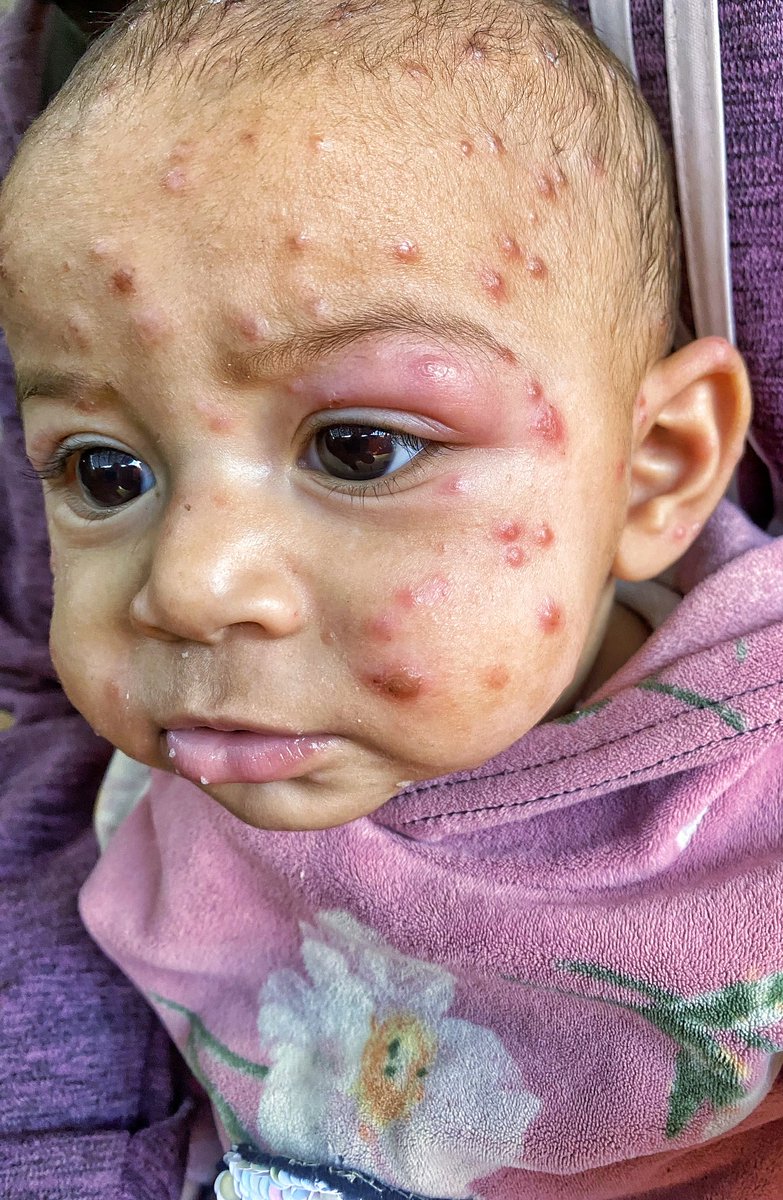 mahmoud60013's tweet photo. Tasneem is the most precious thing I have. I can't see her silent pain. Her little eye is swollen and filled with tears, and the pain follows her every moment. Her face is covered with pimples, spreading quickly through her body. Tasneem can no longer sleep. The weather is making her condition worse, and her eye, which aches and burns, can hardly find rest. Tasneem needs urgent treatment.
https://t.co/V6tQBtnlan