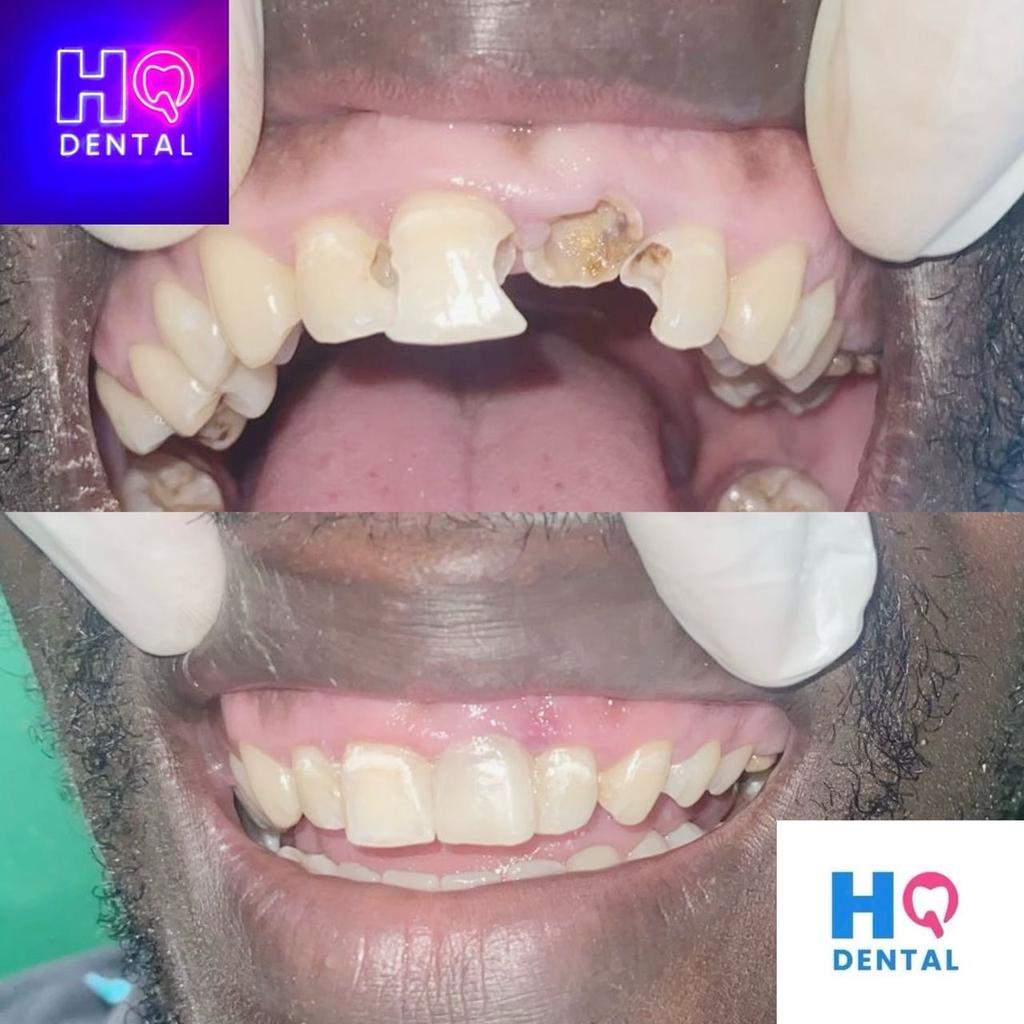 HQ dental ( high quality Dental Est) (@movicati) on Twitter photo 